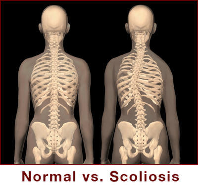 Posisi Normal vs Scoliosis